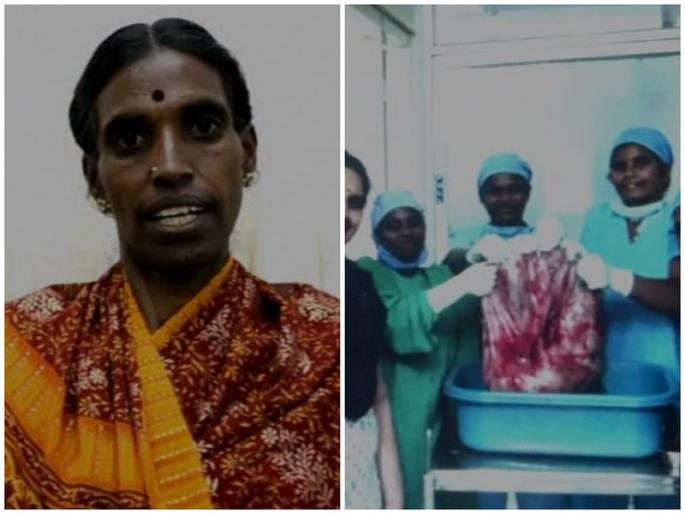 Coimbatore doctors remove 33 5 kg ovarian tumor eye world record | महिलेच्या पोटातून काढली तब्बल 33.5 किलोची गाठ Coimbatore doctors remove 33 5 kg ovarian tumor eye world record | महिलेच्या पोटातून काढली तब्बल 33.5 किलोची गाठ
