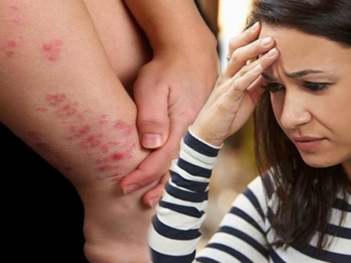How to prevent from fungal infections | अंगाला सतत खाज येते? जाणून घ्या फंगल इन्फेक्शन कसं होईल दूर How to prevent from fungal infections | अंगाला सतत खाज येते? जाणून घ्या फंगल इन्फेक्शन कसं होईल दूर