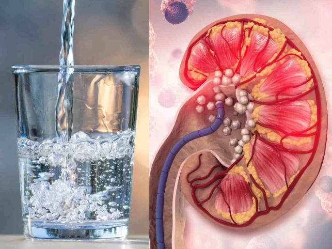 Increase your water intake Avoid the risk of kidney stones how to take care read here | पाणी पिण्याचे प्रमाण वाढवा; किडनी स्टोनचा धोका टाळा! नेमकी कोणती आणि कशी काळजी घ्यावी? वाचा... Increase your water intake Avoid the risk of kidney stones how to take care read here | पाणी पिण्याचे प्रमाण वाढवा; किडनी स्टोनचा धोका टाळा! नेमकी कोणती आणि कशी काळजी घ्यावी? वाचा...
