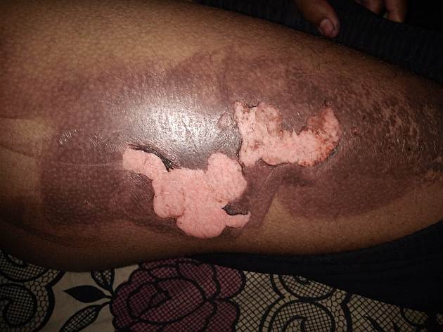 Cruality of the relatives; Hot spring to a 16-year-old boy in a house | नातेवाईकांची क्रुरता; घरात डांबून १६ वर्षीय मुलाला दिले गरम झाऱ्याने चटके Cruality of the relatives; Hot spring to a 16-year-old boy in a house | नातेवाईकांची क्रुरता; घरात डांबून १६ वर्षीय मुलाला दिले गरम झाऱ्याने चटके