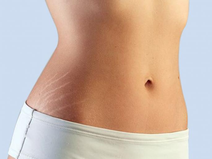 womens health tipsstretch marks causes risk factors symptoms treatment home remedies removal cream | महागड्या क्रिम्सना करा बाय बाय; स्ट्रेच मार्क्स दूर करण्यासाठी 'हे' स्वस्त उपाय