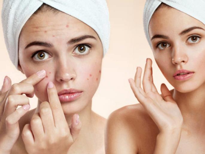 How to remove spot of pimples by using home remedies | पिंपल्सच्या काळ्या डागांनी हैराण झालात? 'या' घरगुती उपायांनी असे घालवा डाग