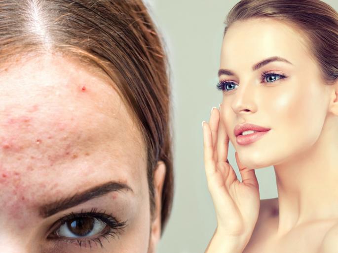 How to remove pimples on face or forehead by using home remedies | कपाळावरच्या डागांमुळे चेहरा खराब झालाय? 'या' उपायांनी डाग होतील दूर How to remove pimples on face or forehead by using home remedies | कपाळावरच्या डागांमुळे चेहरा खराब झालाय? 'या' उपायांनी डाग होतील दूर