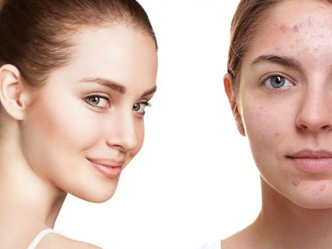 Know the reasons behind pimples and acne | पिंपल्सची 'ही' कारणं तुम्हाला माहीत असतील तरच मिळवाल पिंपल्समुक्त चेहरा Know the reasons behind pimples and acne | पिंपल्सची 'ही' कारणं तुम्हाला माहीत असतील तरच मिळवाल पिंपल्समुक्त चेहरा