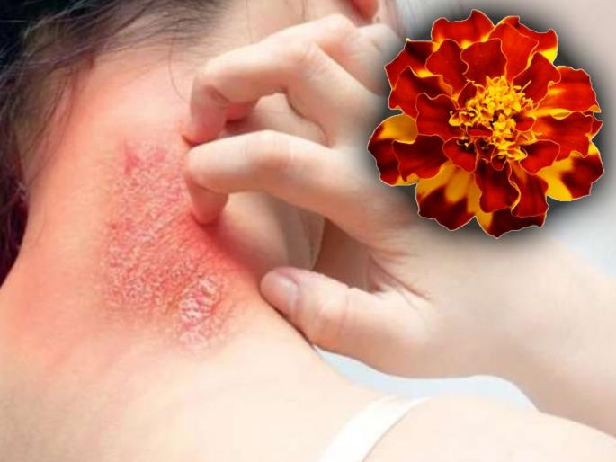 How to remove fungal infection and etching from skin myb | क्रिम्स, पावडरवर खर्च करणं सोडा; खाज, फंगल इन्फेक्शनवर उपाय म्हणून झेंडूची फुलं वापरा