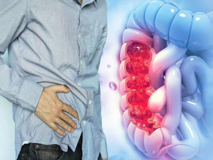 Who is at high risk of colon infection why irfan khan died know the reason myb | 'या' लोकांना कोलन संक्रमणाचा जास्त असतो धोका.... Who is at high risk of colon infection why irfan khan died know the reason myb | 'या' लोकांना कोलन संक्रमणाचा जास्त असतो धोका....