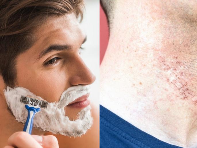 Do not make these mistakes if Pimples and swelling on the skin after shaving myb | 'या' चुकांमुळे शेविंगनंतर त्वचेवर बारीक दाणे येतात, हॅण्डसम लूकसाठी वापरा 'हा' खास फंडा Do not make these mistakes if Pimples and swelling on the skin after shaving myb | 'या' चुकांमुळे शेविंगनंतर त्वचेवर बारीक दाणे येतात, हॅण्डसम लूकसाठी वापरा 'हा' खास फंडा