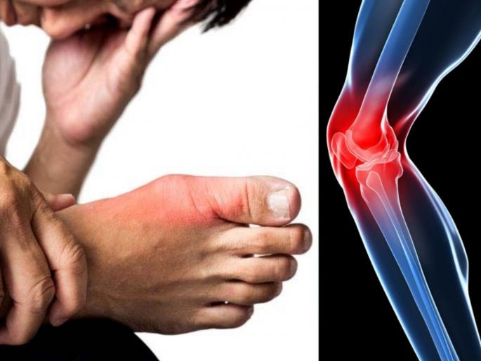 Uric acid causes treatment diet reduce uric acid level naturally myb | युरिक अॅसिडचं वाढतं प्रमाण ठरू शकतं गंभीर आजारांचं कारण, वाचा नियंत्रणात ठेवण्याचे उपाय Uric acid causes treatment diet reduce uric acid level naturally myb | युरिक अॅसिडचं वाढतं प्रमाण ठरू शकतं गंभीर आजारांचं कारण, वाचा नियंत्रणात ठेवण्याचे उपाय