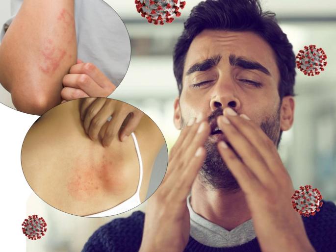 CoronaVirus News : New symptoms of Covid 19; Know in time to prevent infection | त्वचेवरचे 'ते' डाग असू शकतात कोविड 19 चे लक्षणं; कोरोना संसर्ग झाल्यास जाणवतो असा त्रास CoronaVirus News : New symptoms of Covid 19; Know in time to prevent infection | त्वचेवरचे 'ते' डाग असू शकतात कोविड 19 चे लक्षणं; कोरोना संसर्ग झाल्यास जाणवतो असा त्रास