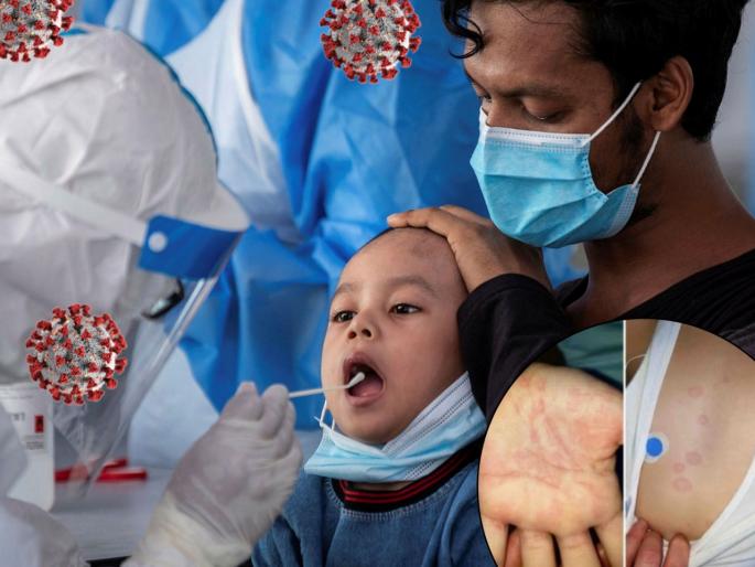 Multisystem inflammatory syndrome in surat dangerous than covid19 | भय इथले संपत नाही! देशात कोरोनापेक्षाही घातक आजाराचा शिरकाव; 'या' शहरात आढळला रुग्ण Multisystem inflammatory syndrome in surat dangerous than covid19 | भय इथले संपत नाही! देशात कोरोनापेक्षाही घातक आजाराचा शिरकाव; 'या' शहरात आढळला रुग्ण