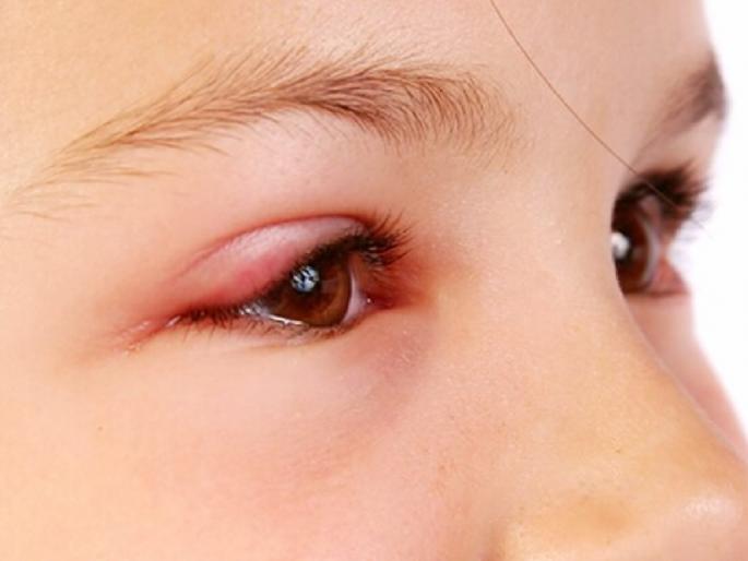 Health Tips : Nephritic syndrome reasons symptoms and treatment | डोळ्यांना सतत सूज येणं 'या' गंभीर आजाराचं असू शकतं लक्षणं; वेळीच सावध व्हा Health Tips : Nephritic syndrome reasons symptoms and treatment | डोळ्यांना सतत सूज येणं 'या' गंभीर आजाराचं असू शकतं लक्षणं; वेळीच सावध व्हा