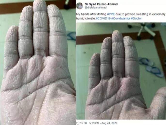 Doctor shared his hand pic says my hands after doffing ppe due to profuse sweating | सलाम! कधीही विसरणार नाही रात्रंदिवस राबणाऱ्या कोरोनायोद्ध्याचं बलिदान; मन हेलावून टाकणारा फोटो Doctor shared his hand pic says my hands after doffing ppe due to profuse sweating | सलाम! कधीही विसरणार नाही रात्रंदिवस राबणाऱ्या कोरोनायोद्ध्याचं बलिदान; मन हेलावून टाकणारा फोटो