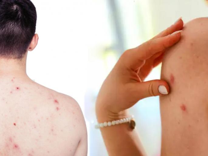 Reasons of back acne and home remedies to cure the problem | त्वचेवरील सक्रिय किटाणूंमुळे पाठीवर दाण्यांसारखे डाग पडतात; 'या' घरगुती उपायांनी ठेवा दूर Reasons of back acne and home remedies to cure the problem | त्वचेवरील सक्रिय किटाणूंमुळे पाठीवर दाण्यांसारखे डाग पडतात; 'या' घरगुती उपायांनी ठेवा दूर