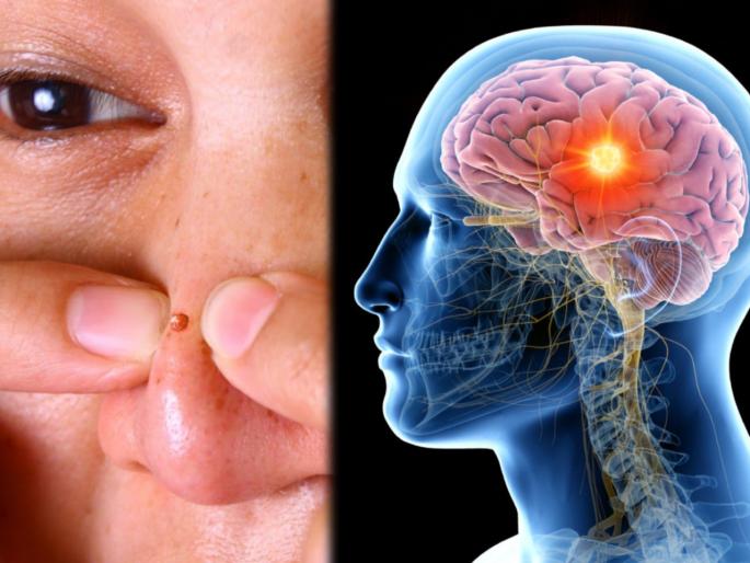 China girl popping pimple on nose with hand cause severe brain infection | हाताने नाकावरचे पिंपल्स फोडणं चांगलंच अंगाशी आलं; मेंदूत झालं गंभीर इन्फेक्शन अन् मग... China girl popping pimple on nose with hand cause severe brain infection | हाताने नाकावरचे पिंपल्स फोडणं चांगलंच अंगाशी आलं; मेंदूत झालं गंभीर इन्फेक्शन अन् मग...