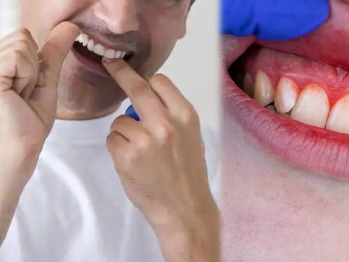 Oral Health Tips: Add vitamin c to your diet to prevent bleeding gums problems | हिरड्यांमधून येणाऱ्या रक्ताकडे दुर्लक्ष करणं पडू शकतं महागात; वाचा हिरड्या निरोगी ठेवण्याचा सोपा उपाय