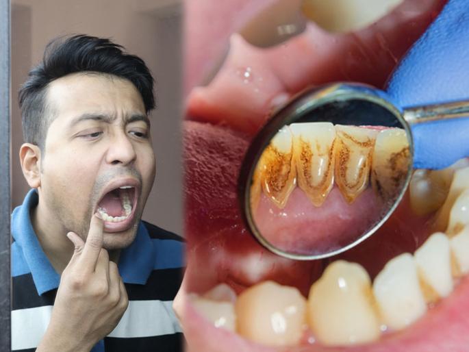Heath tips : How to remove plaque from teeth naturally by using home remedies | दातांच्या पिवळेपणामुळे चारचौघात लाज वाटतेय? मग चिंता सोडा, या घरगुती उपायांनी मिळवा चमकदार दात Heath tips : How to remove plaque from teeth naturally by using home remedies | दातांच्या पिवळेपणामुळे चारचौघात लाज वाटतेय? मग चिंता सोडा, या घरगुती उपायांनी मिळवा चमकदार दात