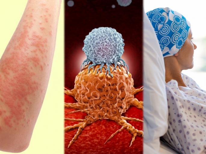 These 6 common symptoms may be a sign of blood cancer | सामान्य वाटणारी 'ही' ६ लक्षणं असू शकतात ब्लड कॅन्सरचा संकेत; दुर्लक्ष करू ठरेल जीवघेणं  These 6 common symptoms may be a sign of blood cancer | सामान्य वाटणारी 'ही' ६ लक्षणं असू शकतात ब्लड कॅन्सरचा संकेत; दुर्लक्ष करू ठरेल जीवघेणं