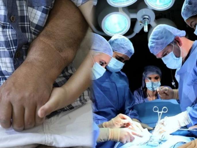Amputated hand re joined in challenging surgery at delhi hospital | देव तारी त्याला कोण मारी! मशिनमध्ये हात अडकून दोन भाग झाले; अन् डॉक्टरांनी केला असा चमत्कार