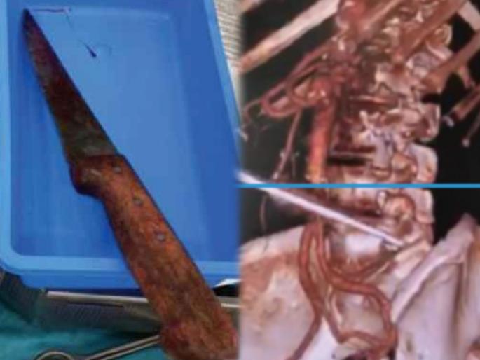 Woman slips while gardening knife got stuck in her abdomen news in | भयंकर! बागेत फिरत असताना ८२ वर्षीय महिलेच्या पोटात शिरला १८ सेमी लांब चाकू; अन् मग.... Woman slips while gardening knife got stuck in her abdomen news in | भयंकर! बागेत फिरत असताना ८२ वर्षीय महिलेच्या पोटात शिरला १८ सेमी लांब चाकू; अन् मग....