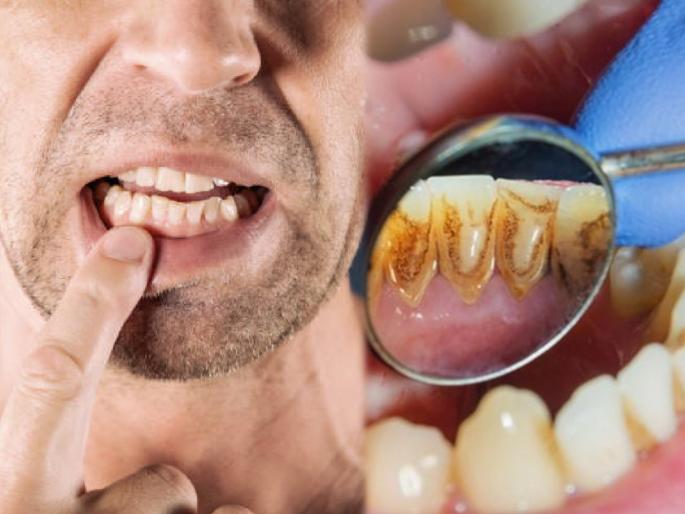 People having crooked teeth should avoid eating this food items | Oral Health Care Tips : वाकडे तिकडे दात असतील तर 'या' पदार्थांचे सेवन आजच बंद करा; दात कधी किडतील कळणारही नाही People having crooked teeth should avoid eating this food items | Oral Health Care Tips : वाकडे तिकडे दात असतील तर 'या' पदार्थांचे सेवन आजच बंद करा; दात कधी किडतील कळणारही नाही