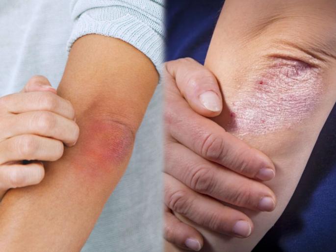 Health Tips in Marathi : 10 ways to treat psoriasis at home | वाढत्या गरमीत त्वचेवर खाज आल्यानं तुम्हीही होऊ शकता सोरायसिसचे शिकार; वेळीच जाणून घ्या उपाय Health Tips in Marathi : 10 ways to treat psoriasis at home | वाढत्या गरमीत त्वचेवर खाज आल्यानं तुम्हीही होऊ शकता सोरायसिसचे शिकार; वेळीच जाणून घ्या उपाय