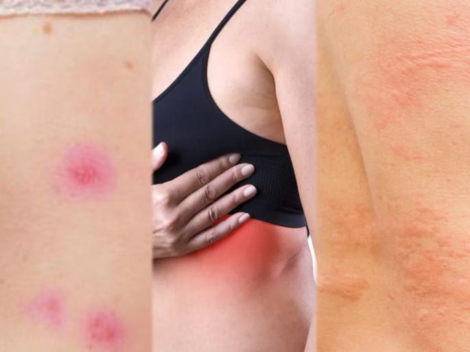 Easy home remedies for rashes and etching under breast | उन्हाळ्यात घामाने छातीखाली खाज येतेय? या उपायांनी मिळेल आराम