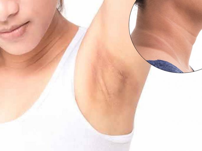 How to remove tanning of neck and underarms here's simple solutions | घामामुळे आलेला मानेवरचा अन् अंडरआर्म्सचा काळपटपणा कसा घालवाल? जाणून घ्या सोपे उपाय