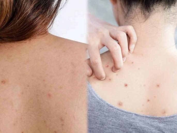Back acne Reasons and Remedies: Causes and treatment of back acne Reasons and Remedies | तुमचं सौंदर्य बिघडवू शकतात पाठीवर येणारे बारिक बारिक दाणे; 'या' घरगुती उपायांनी ठेवा दूर
