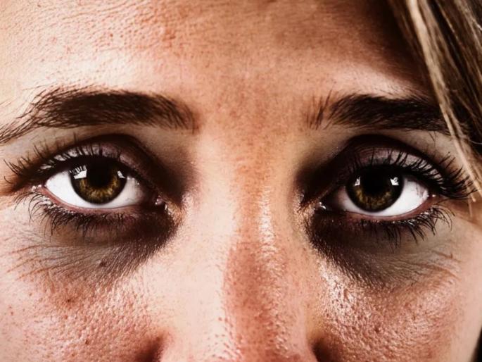How To remove dark circles : All about dark circles and how to treat them common causes of dark circles | टेंशनमुळे येणारे डार्क सर्कल्स, डोळ्याखालचे काळे पट्टे कायमचे निघून जातील; त्यासाठी 'या' सोप्या टिप्स