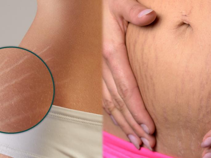 How remove stretch marks take care your skin 7 tips given experts | लूक बिघडवणारे स्ट्रेच मार्क्स कायमचे होतील दूर; महागड्या क्रिम्स नाही तर वापरा हे सोपे घरगुती उपाय