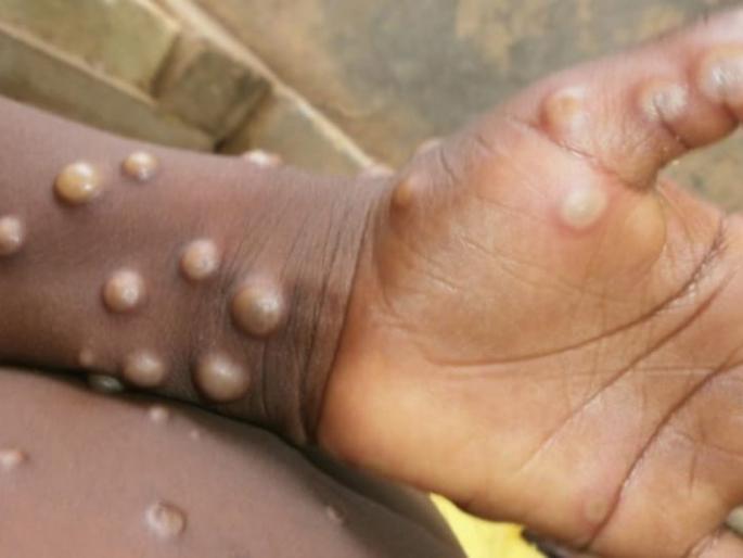 Monkeypox: New virus found in Britain, such are the symptoms, how dangerous can it be? Find out | मंकीपॉक्स: ब्रिटनमध्ये सापडला नवा विषाणू, अशी आहेत लक्षणे, कितपत ठरू शकतो धोकादायक? जाणून घ्या   Monkeypox: New virus found in Britain, such are the symptoms, how dangerous can it be? Find out | मंकीपॉक्स: ब्रिटनमध्ये सापडला नवा विषाणू, अशी आहेत लक्षणे, कितपत ठरू शकतो धोकादायक? जाणून घ्या