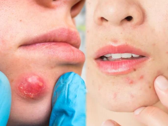 Pimples Prevention : Boils vs pimples signs causes prevention tips | Pimples Prevention : पिंपल्स आणि फोड यातील फरक कसा ओळखाल? वाचा या दोन्ही समस्यांची कारणं आणि उपाय