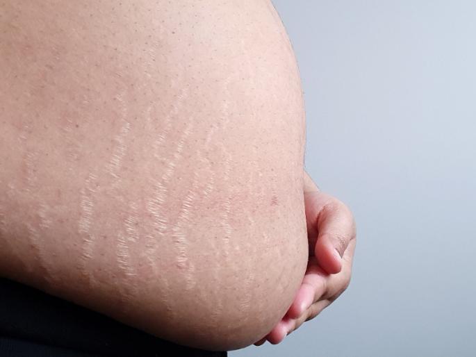 Beauty tips : How to get rid of stretch marks, home remedies | पोटावरचे स्ट्रेचमार्क जाता जात नाहीत, हे घरगुती प्रभावी उपाय करा, स्ट्रेचमार्क छू मंतर!