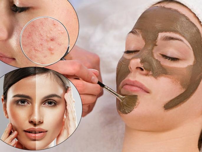 Skin Care Tips : Multani mitti facepack to prevent monsoon skin problems | पिंपल्स, सुरकुत्या घालवण्यासाठी मुलतानी मातीचा होममेड फेसपॅक; काही सेकंदात मिळेल ग्लोईंग त्वचा