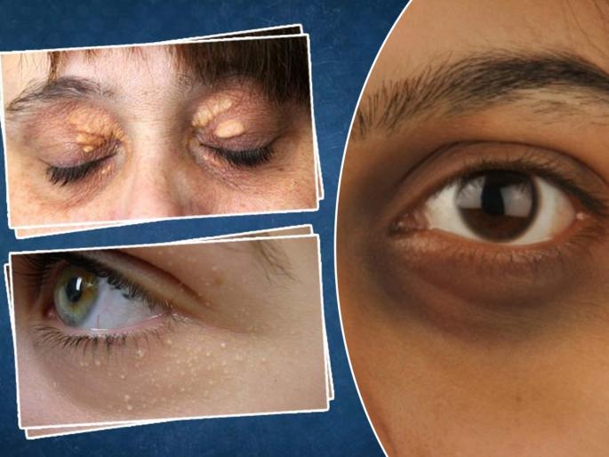 Skin Care Tips : 5 modern treatments to remove cholesterol deposits on eyelids or xanthelasma | Skin Care Tips : डोळ्यांजवळ जमा झालेल्या कॉलेस्ट्रॉलच्या खुणा कशा घालवाल? जाणून घ्या योग्य उपाय