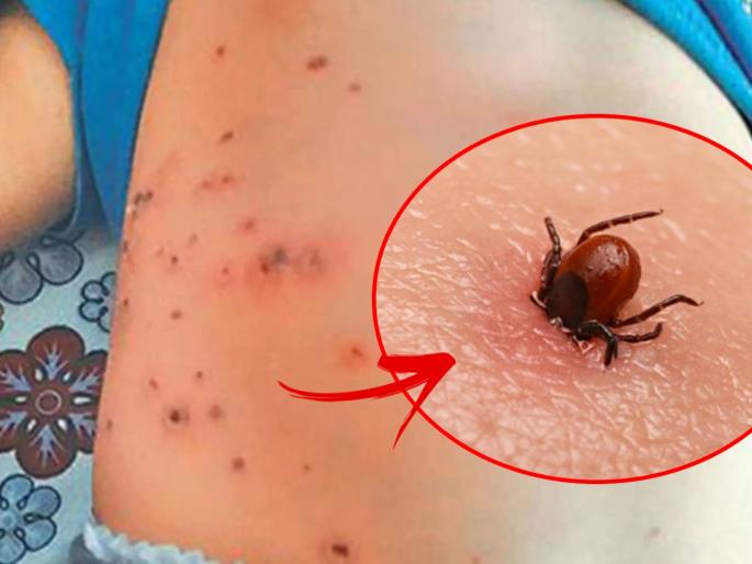 causes symptoms remedies of scrub typhus after corona danger of scrub typhus | कोरोना, डेंग्यू पाठोपाठ आता स्क्रब टायफसचा धोका, वेळीच लक्षणं जाणून घ्या नाहीतर ओढावेल मृत्यू