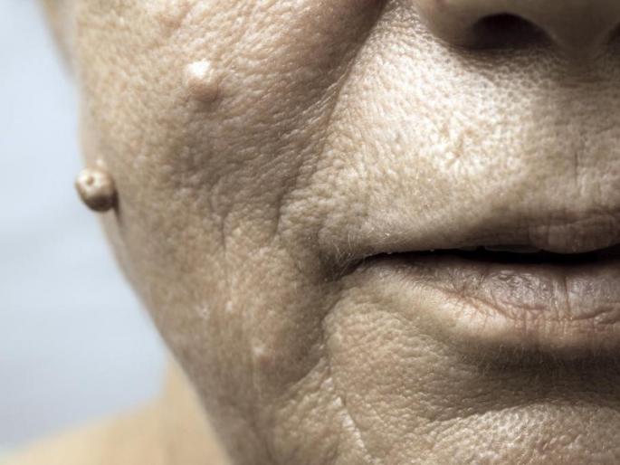 home remedies to get rid of warts | शरीरावरील चामखीळींनी त्रस्त आहात मग 'हे' उपाय करुन पाहाच, त्रासापासून कायमचे मुक्त व्हाल home remedies to get rid of warts | शरीरावरील चामखीळींनी त्रस्त आहात मग 'हे' उपाय करुन पाहाच, त्रासापासून कायमचे मुक्त व्हाल