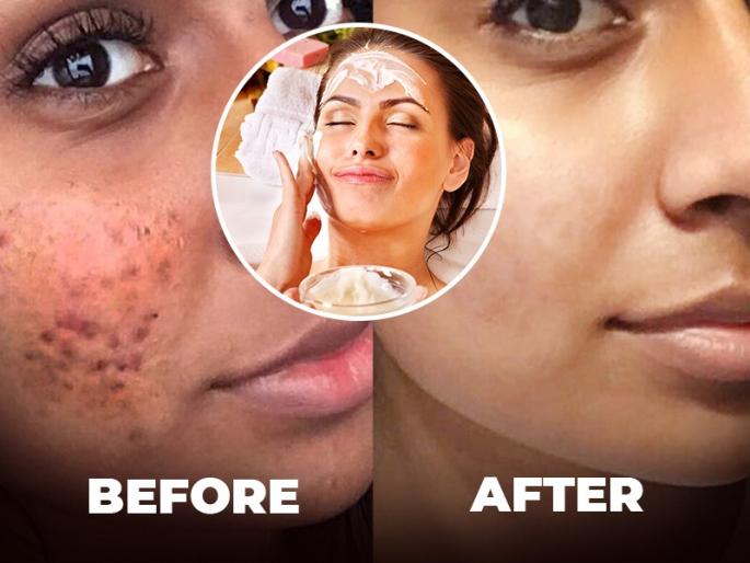 Skin Care Tips Winter Care : Curd makes your face fairer best homemade face pack | Skin Care Tips Winter Care : पिंपल्स, काळपटपणानं चेहरा खराब झालाय? फक्त दह्याचा असा वापर करून मिळवा सॉफ्ट, ग्लोईंग त्वचा