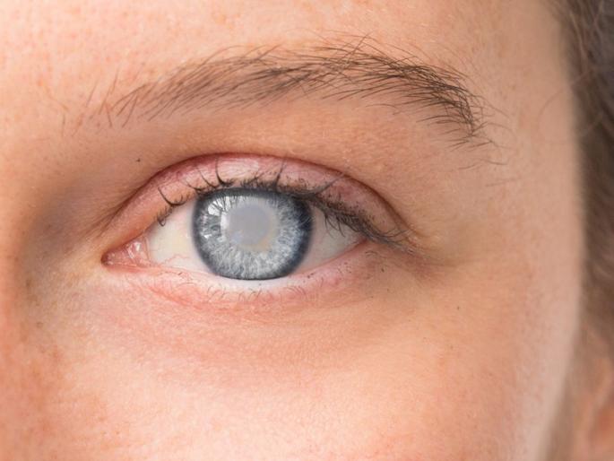 cataract new implant treatment found by scientist will avoid operation risk | मोतीबिंदुच्या समस्येवर शास्त्रज्ञांचा नवा शोध, ना ऑप्रेशन ना ट्रीटमेंट फक्त 'हे' औषध वापरणार