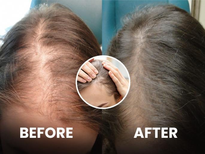 Frontside Hair Loss : How to stop hair fall Different types of hair loss reason symptoms and prevention | Frontside Hair Loss : कपाळ मोठं दिसू लागलंय का? टक्कल पडण्याचं लक्षण तर नाही हे?