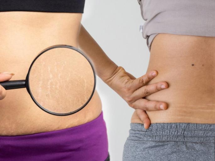 Stretch Marks Removal Tips : Dermatologist shares tips to deal with stretch marks | Stretch Marks Removal Tips : पोट, कंबरेवरचे स्ट्रेच मार्क्स लूक बिघडवतात? फक्त ३ उपाय, स्ट्रेच मार्क्सच्या खूणा कायमच्या होतील दूर