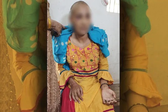Woman shaved off her head for dowry, thrown to the canel bank | हुंड्यासाठी महिलेचे मुंडण करून काढली धिंड, बेशुद्ध पडल्यावर दिले फेकून Woman shaved off her head for dowry, thrown to the canel bank | हुंड्यासाठी महिलेचे मुंडण करून काढली धिंड, बेशुद्ध पडल्यावर दिले फेकून