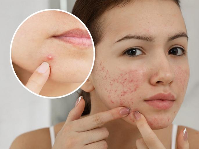Beauty Tips: Lots of pimples due to heat in summer? 5 simple remedies for reducing pimples | उन्हाळ्यात चेहऱ्यावर पिंपल्स खूप वाढलेत? ५ उपाय, त्वचेला थंडावा आणि पिंपल्सही होतील कमी