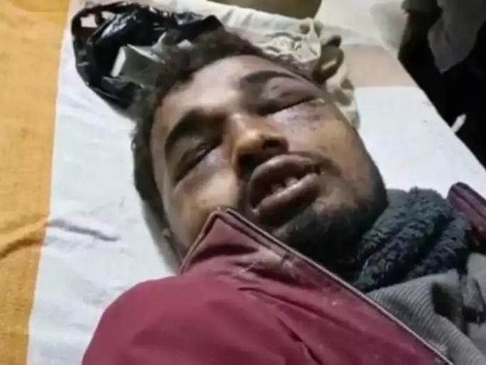 Brutal punishment! he looked at daughter in law so hurt eyes ?; Beaten and poured acid in both eyes | क्रूर शिक्षा! सुनेकडे पाहिले म्हणून डोळे फोडले?; मारहाण करून दोन्ही डोळ्यात ॲसिड ओतले