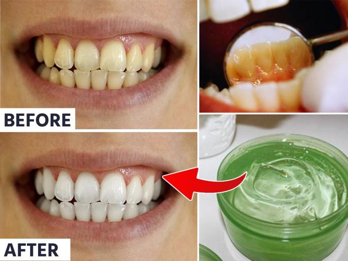 How to Get Rid of Yellow Teeth : How to make tooth gel with aloe vera homemade toothpaste for yellow teeth | दातांचा पिवळटपणा दूर करेल 'ही' घरगुती टुथपेस्ट; दात दिसतील पांढरेशुभ्र- चमकदार