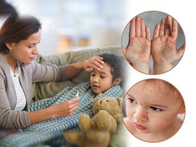 Hand Foot and Mouth Symptoms : hand foot and mouth precautions hand foot and mouth disease vs monkeypox | Hand Foot and Mouth Symptoms : पावासाळ्यात मुलं तापानं फणफणली, अंगावर पुरळ? मंकीपॉक्स म्हणून घाबरू नका, वाचा डॉक्टरांचा सल्ला....
