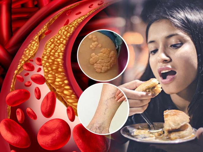 High Cholesterol Foods :  High Cholesterol Foods High you should avoid in diet | High Cholesterol Foods : कॉलेस्टेरॉलचं प्रमाण वाढवतात रोजच्या खाण्यातले ६ पदार्थ; चांगल्या तब्येतीसाठी आजपासूनच खाणं सोडा