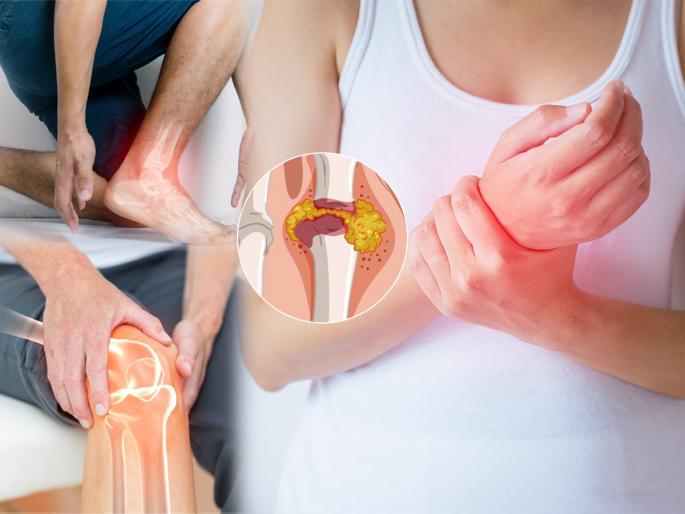 Uric Acid Removal Food :  According to ncbi study bitter gourd is a effective way to reduce high uric acid naturally | शरीरातल्या घातक युरीक अ‍ॅसिडला बाहेर फेकेल 'हा' पदार्थ;  हाडांची दुखणी राहतील लांब