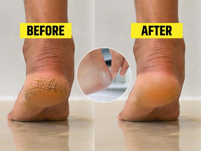 Home made cream for cracked heels, Home remedies for cracked heel | भेगाळलेल्या टाचांसाठी खास होममेड क्रिम.. फक्त ४ गोष्टी वापरा, टाचा होतील मऊ- मुलायम