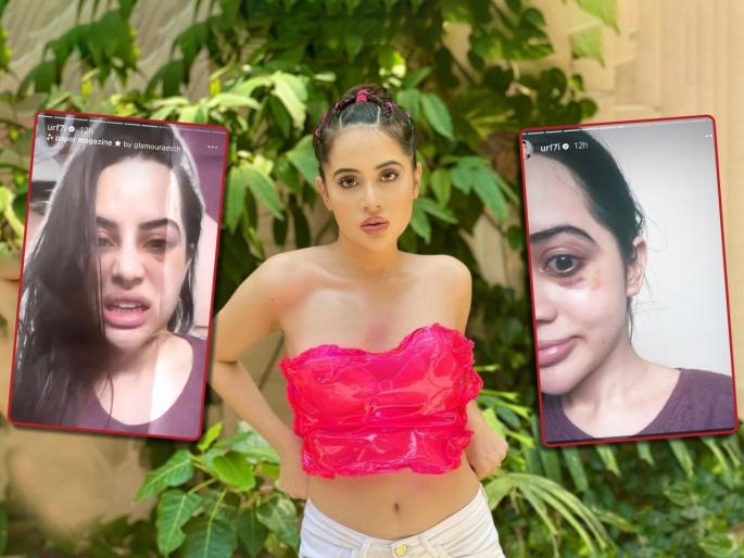 Swollen face, dark circles under the eyes...fans were shocked to see the condition of Urfi Javed | सुजलेला चेहरा, डोळ्याखाली काळी वर्तुळं...उर्फी जावेदची अवस्था पाहून हैराण झाले चाहते